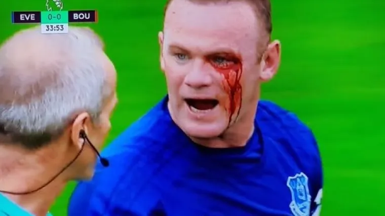 Engleski napadač skoro ostao bez oka, pogledajte udarac za zatvor