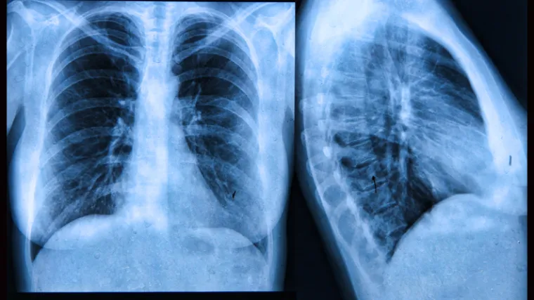 'Rak vi&scaron;e nije smrtonosna bolest, sad je kronična, mnogi s time žive'