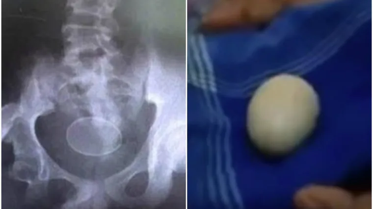 Tinejdžer izlegao jaje pred zbunjenim liječnicima