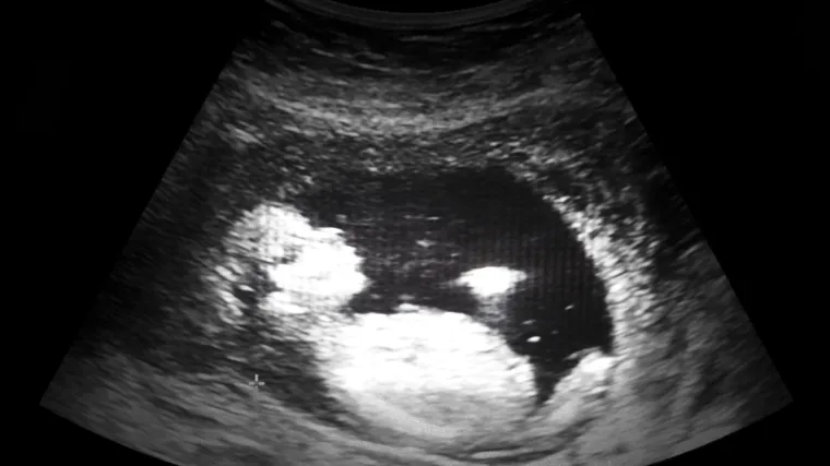 'Tulum' u maminom trbuhu postao hit na internetu