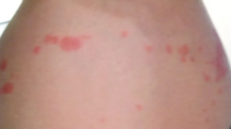 Kako se riješiti stjenica - Riješite se stjenica jednostavnim savjetima