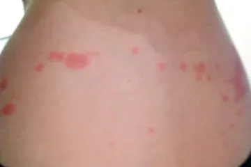 Kako se riješiti stjenica - Riješite se stjenica jednostavnim savjetima