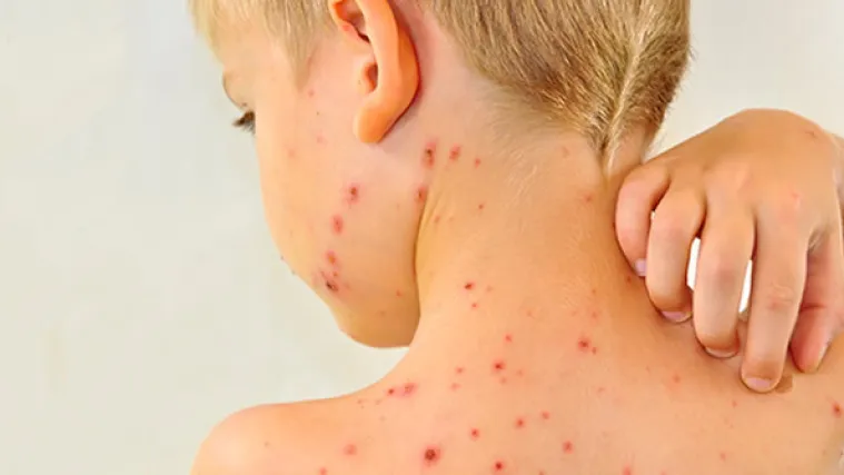 Prijeti epidemija zarazne bolesti, oboljeli dječak nije cijepljen