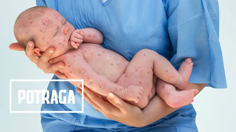 Hrvatska se na&scaron;la na rubu epidemije ospica:  jesu li za sve krivi neodgovorni roditelji?