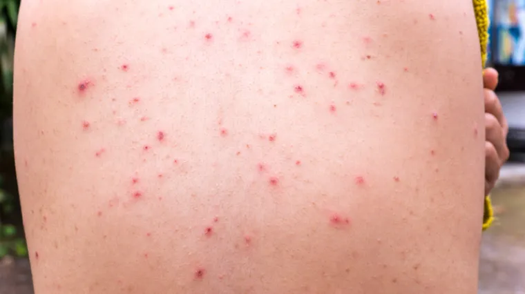 'U Dubrovniku postoje sve objektivne okolnosti za izbijanje epidemije'