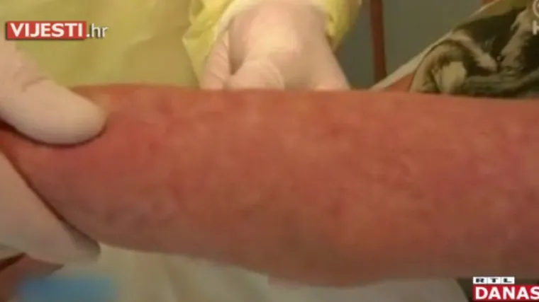 Kako je moguće da se ospicama zarazi osoba koja je cijepljena?