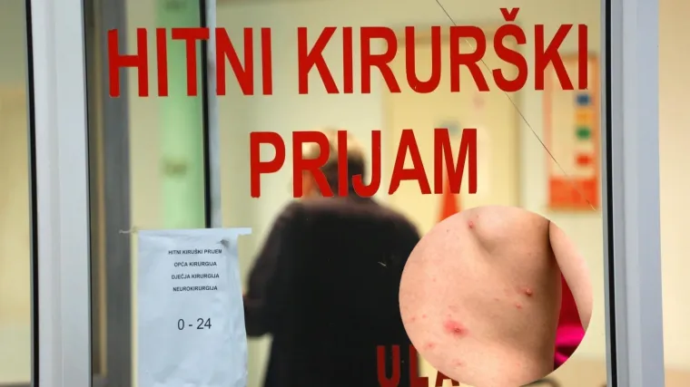 Slučaj ospica u Splitu: 'Možemo očekivati ovakvih situacija, turistička sezona je u tijeku'