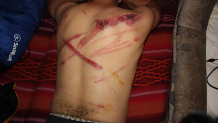 FOTO Potresna objava aktivista: 'Ovako izgledaju leđa migranta nakon susreta s hrvatskom policijom'