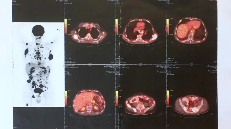 Zahvaća sve veći broj djece: Rapidan porast oboljelih od karcinoma u Hrvatskoj