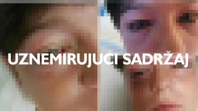 FOTO, VIDEO Dječak (11) se te&scaron;ko ozlijedio poku&scaron;avajući ponoviti 'foru' s YouTubea