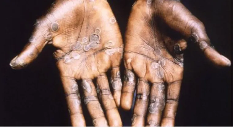 U Europu stigla bolest majmunskih boginja: o čemu je riječ i je li strah opravdan?