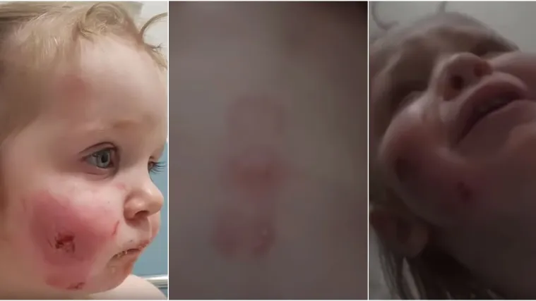 Izgrizli djevojčicu (1,5) u igraonici: 'Izgleda kao da su je napali bijesni psi, a ne djeca!'