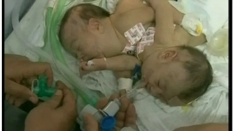 Doktori razdvojili sijamske blizanke: Sestre spojene torzom i jetrom konačno spavaju odvojeno!