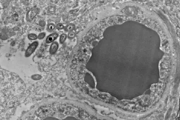 Otkrivena bakterija koja putem krvi iz crijeva dospije u mozak