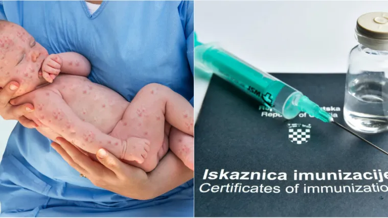 Europa ipak neće biti bez ospica do 2020. godine: Zabilježeno najvi&scaron;e slučajeva ovog stoljeća