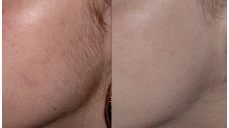 Konačno bezbolno uklanjanje dlaka &ndash; Neželjene dlačice odlazite!
