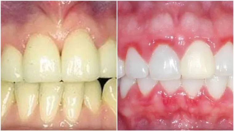 Stomatologinja okrila kako otkriti jesu li vam zubi zdravi bez odlaska zubaru