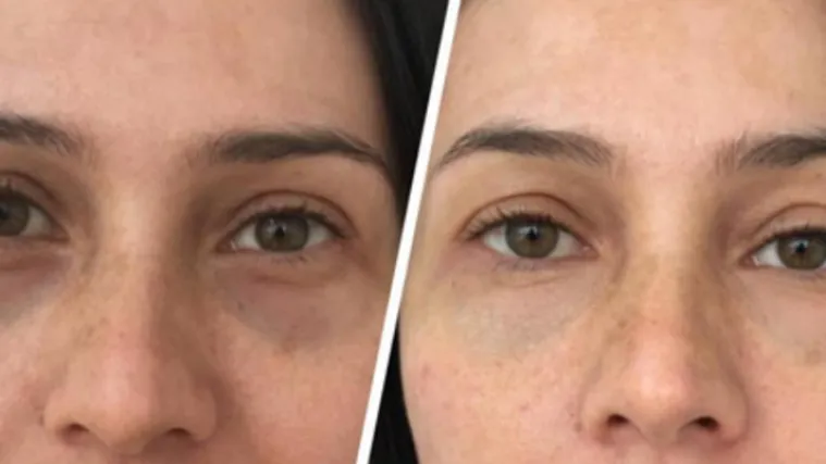 Zaboravite zauvijek na crne krugove pod očima. Podočnjaci se odsad tetoviraju