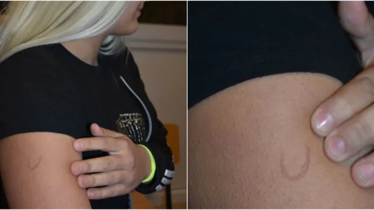 Ravnatelj o 'žigosanju': 'Zagrijani upaljač naslonio je učenici na rame. To je obična dječja igra'