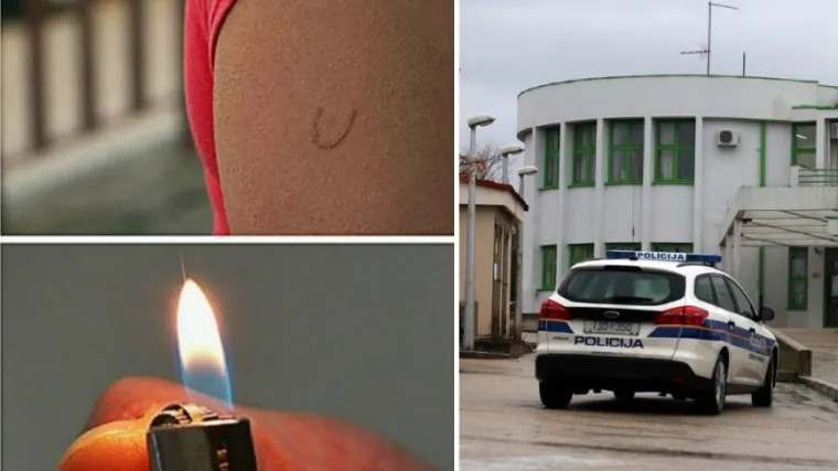 Djevojci užarenim upaljačem napravio 'U' na ruci: Policija podnijela kaznenu prijavu protiv 15-godi&scaron;njaka