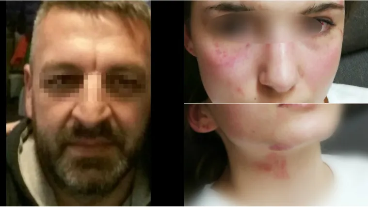 Majka djevojčice koju je pretukao otac, biv&scaron;i specijalac, objavila fotke: 'Da...To je moja kći pretrpjela'