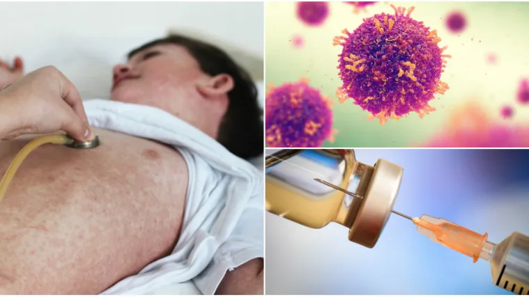 Ne želite cijepiti svoju djecu protiv ospica? Kazna - 2500 eura i zabrana dolaska u vrtiće!