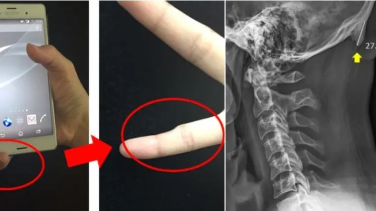 Sefie-zglobovi, krivi mali prsti, a sad i ROGOVI na vratu: Mobiteli mijenjaju ljudsku fizionomiju