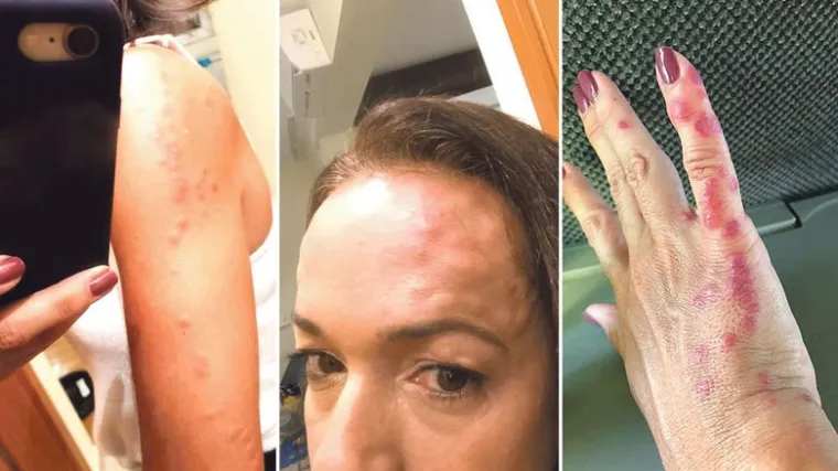 FOTO Grozno! U Zadru je izgrizle stjenice: 'Mislila sam da su komarci, ali moje tijelo je bilo 'pojedeno'