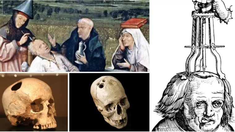 &Scaron;to je trepanacija? 'Na&scaron;i stari' bu&scaron;ili su si glave na živo kako bi se rije&scaron;ili psihičkih poremećaja i glavobolje