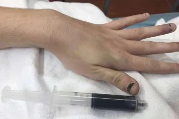 Ovo se može dogoditi i vama ako pretjerate s tabletama protiv bolova!