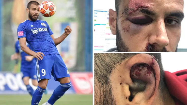 FOTO Nogometa&scaron; Slaven Belupa nije napao već je napadnut &scaron;ipkom. Pogledajte kako izgleda!
