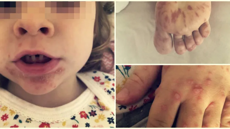 FOTO 'Razboljeli smo se u hotelu u Rovinju. Plikovi bole kao da ti čavle zabadaju u kožu'