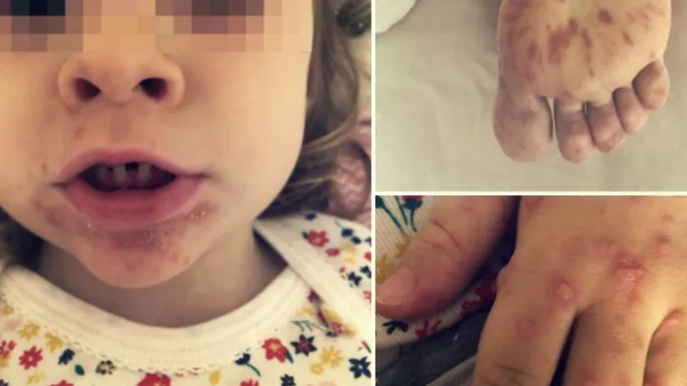 'Izgleda stra&scaron;no, a svaki plik boli kao da ti netko zabija čavao u kožu'