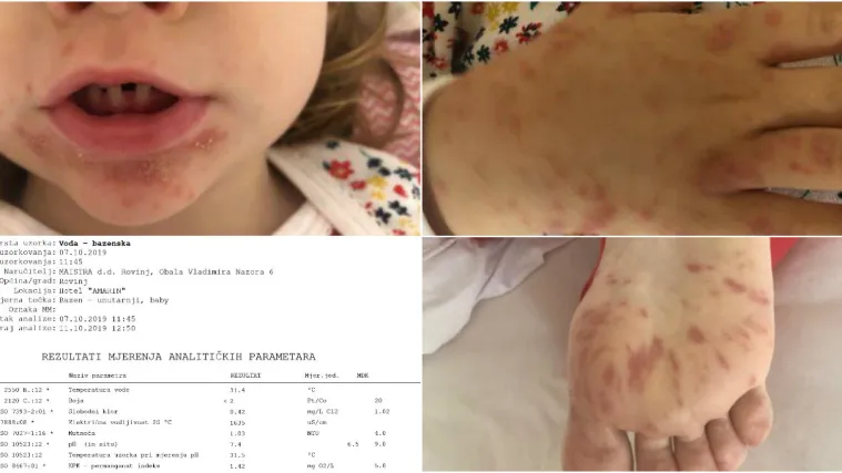 FOTO Obitelj okrivila hotel iz Rovinja za zarazu i bolne plikove: Evo &scaron;to su im poručili iz poznatog resorta