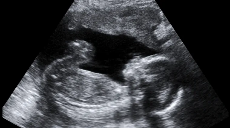 Tragičan slučaj u Portugalu: Beba Rodrigo rođena je bez lica - očiju, nosa i dijelova lubanje. I živ je