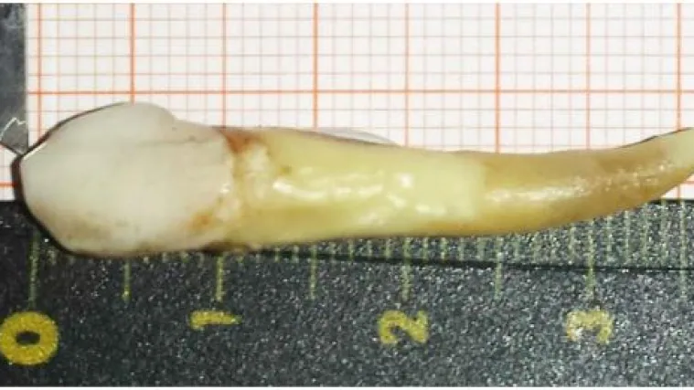 Hrvatu izvađen zub dug 3,72 centimetra - postavio je novi Guinnessov rekord