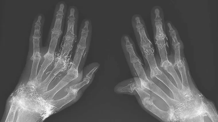 Žalila se na bol u zglobovima, a liječnike je zapanjilo ono &scaron;to su vidjeli na rendgenu