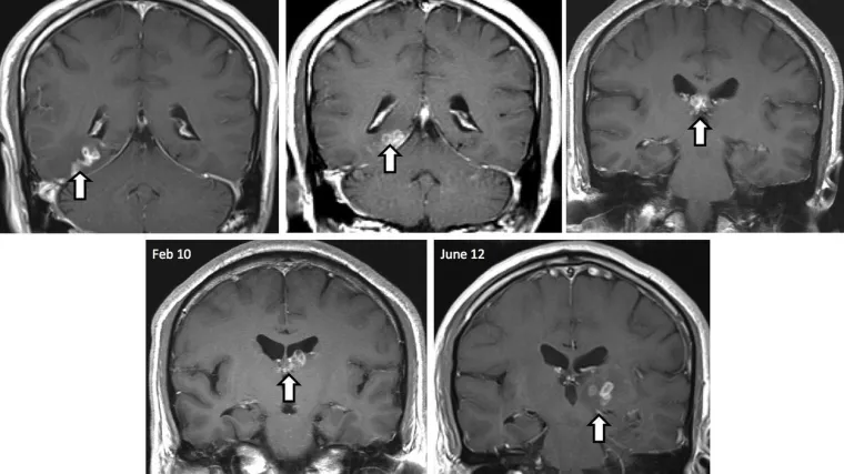 'Bila je živa i kretala mu se po mozgu'