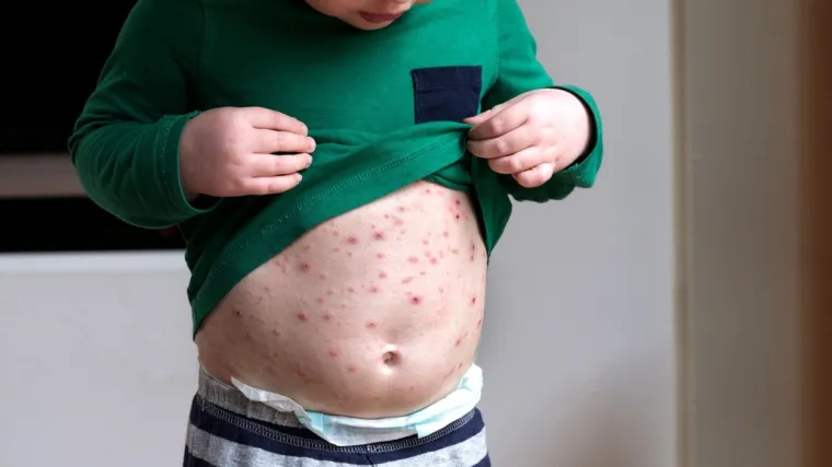 Epidemiologinja &Scaron;lezak o vodenim kozicama: Koji su simptomi, komplikacije i kako njegovati oboljelo dijete