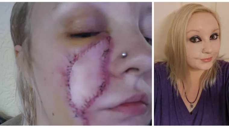 Nakon 30 godina ožiljak od vodenih kozica postao rak kože: 'Prvo je bila krasta pa su krenule infekcije'