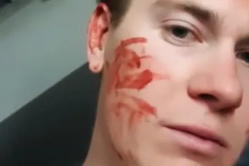 Zubčić se sam pokušao ošišati i raskrvario si uho; 'Niš, glup sam...'