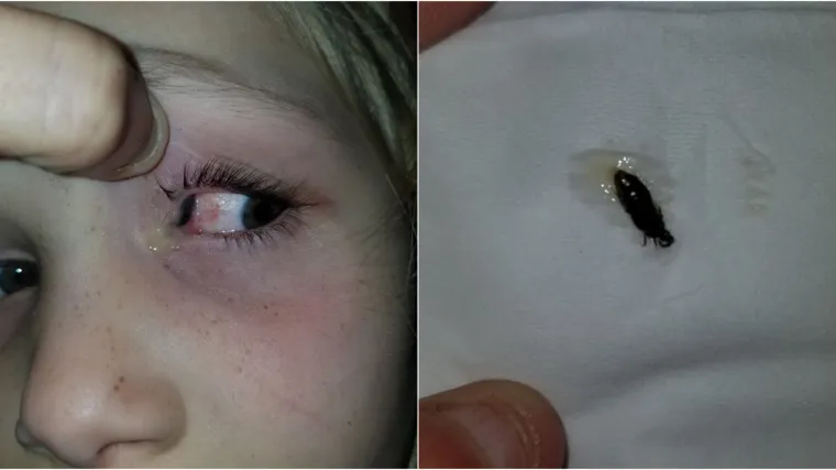 Majka objavila uznemirujuće fotke kukca koji je zapeo u oku njezine kćeri (6)