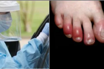 Vjerovali ili ne: 'Covid nožni prsti' su još jedan moguć simptom zaraze koronavirusom