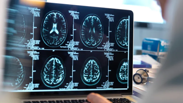Snimke mozga otkrile neobjašnjiv poremećaj, ovo je još jedan dokaz koliko je virus opasan