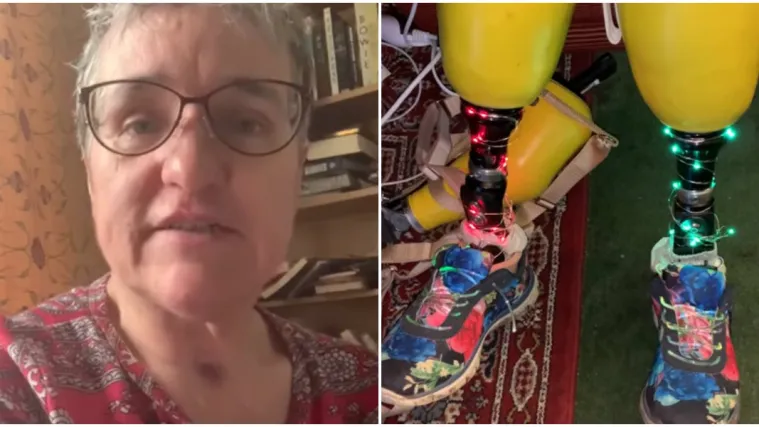 Upozorenje žene kojoj su zbog koronavirusa amputirali ruke i noge: 'Moje &scaron;ake i stopala bili su crni...'