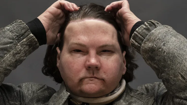 FOTO/VIDEO Druga prilika za život: Ovo je pacijent kojem su prvi put na svijetu uspje&scaron;no transplantirali i lice i ruke