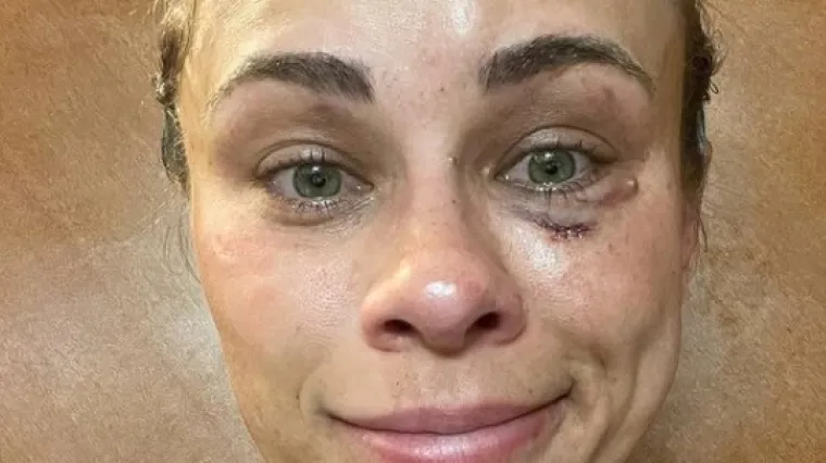 Lijepa Amerikanka pokazala razmjere ozljeda