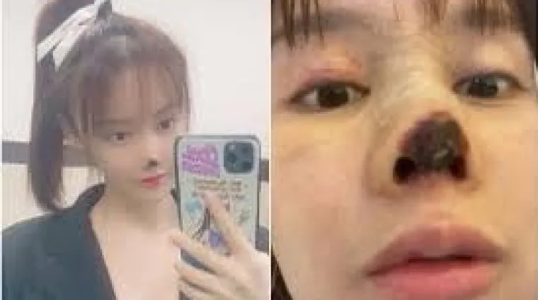 Oti&scaron;la na estetsku operaciju nosa, a na kraju je ostala bez njega! 'Mislila sam da ću biti ljep&scaron;a'