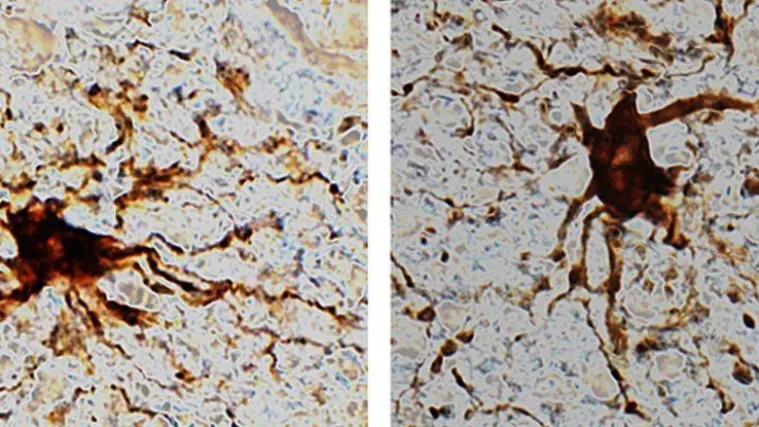 Znanstvenici su otkrili da se u ljudskom mozgu nakon smrti razvijaju 'zombi stanice'