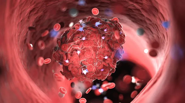 U Britaniji zabilježeno 30 slučajeva stvaranja krvnih ugru&scaron;aka nakon primanja AstraZenecinog cjepiva